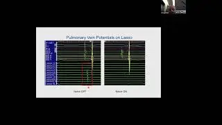 Intracardiac signal processing Biophysics of Cardiac Ablation by Prof  Ahmed Nabil, MD