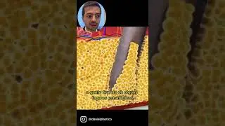 Como &eacute; feita a Lipo Hd