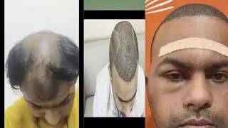 My hair transplant from day 0 to day 12 kya khaye kya nahi precautions first head wash shedding#hair