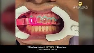 Whitening with the D-Storm&trade; Diode Laser