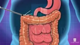 Mini Gastric Bypass Sugery Tijuana M&eacute;xico - LIMARP / DR. POMPA