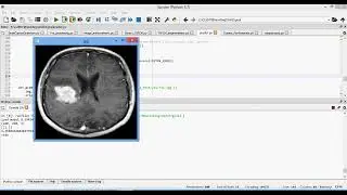 Efficient nnU Net for Brain Tumor Segmentation