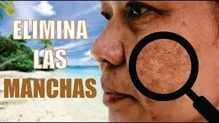 COMBATE el MELASMA de la CARA 👩 MANCHA EN CARA o PAÑO 😱 DRA. KATERYN PEREZ WILLIS *** DERMALASER KPW