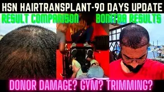 90 Days Hair Transplant results 🔥🔥🔥| #HSNBangalore #ameerht #hairtransplanttamil #tamilanht #ameerht