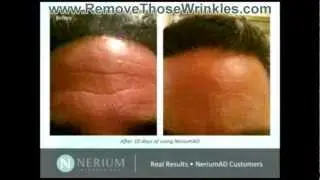 Remove Those Wrinkles - Before and Afters With Nerium AD