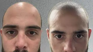 Trapianto di capelli in Turchia - prime due settimane nel dettaglio - dichiarazione dei redditi 730!