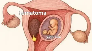 Early Pregnancy Failure on Ultrasound: Missed Abortion with Subchorionic Hematoma Explained