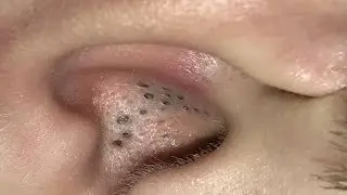 БЫСТРО И ЛЕГКО УДАЛИТЬ ЧЕРНЫЕ ТОЧКИ