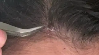 Выщипывание крупных корочек на коже головы