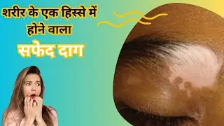 Segmental Vitiligo: Understanding the Rare Skin Condition!