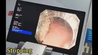 Shanlian's independently developed hydrogel module for endoscopic submucosal dissection (ESD).