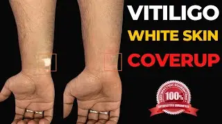 Vitiligo white skin coverup | 100% Results | Machu tattoo studio | Bangalore