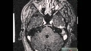 Mastoiditis Brain Abscess DISCUSSION