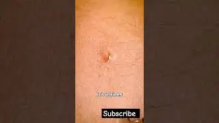 Bee sting to Death ☠️#facts #science #bee #viralvideo