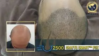 SMART™️ FUE 2,500 Grafts @ Hair Transplant Malaysia Specialist