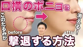 【口横のポニョ】を撃退する治療方法を４つ紹介します