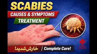 Scabies: Causes, Symptoms & Complete Treatment | Doctor&nbsp;Explains
