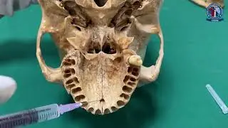 Nasopalatine Nerve Block