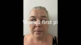 Voula DeBenedictis treating Aging Skin in TSG2025 - Video 6