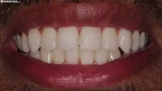 Before & After Teeth Whitening - White Spots Marks DMG Icon - Teeth Bonding Veneers Composite