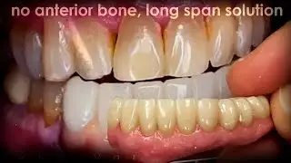 Long Span Solution for Patient With No Anterior Bone