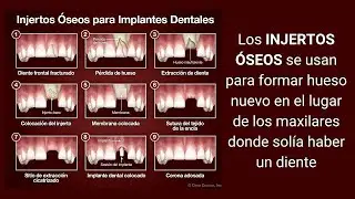 INJERTOS &Oacute;SEOS para la colocaci&oacute;n de IMPLANTES DENTALES