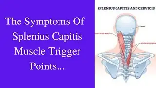 The Symptoms Of The Splenius Capitis Trigger Points | Physiotherapy | Trigger Points