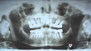 6   7   Lecture 7  Persistent Idiopathic Facial Pain 11min