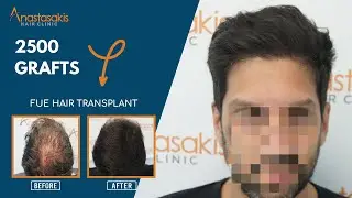 ⭐⭐⭐⭐⭐Case #224 - Δείτε το αποτέλεσμα με 2500 FUs - Anastasakis Hair Clinic