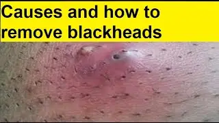 causes and how to remove blackheads