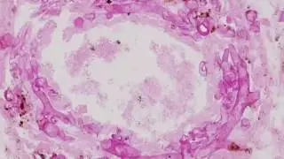 Clinical Mycology: Direct Examination Series: Zygomycetes [Hot Topic]