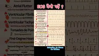 ECG Report | How To Read ECG | Abnormal ECG | Normal ECG #10millionviews #trending #ytshorts