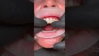24 Composite Veneers, 2 Hours, 1 Day, 0 Tooth Prep💥