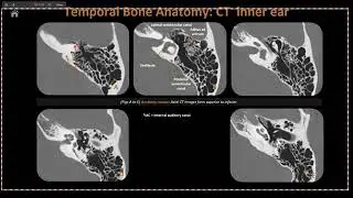Session 129  Radiology Interactive Course, Neuro imaging cases review, Prof   Ayda Youssef