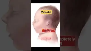 Anotia & Microtia in newborn birth defect. #congenital #birthdefects #newborn #baby #mbbs #nurse.