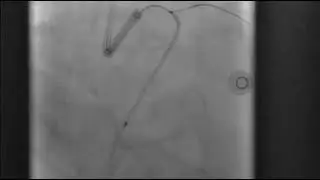 PCI to CTO LCX using microcatheter assisted antegrade wire escalation with LCX-OM TAP(case 3)