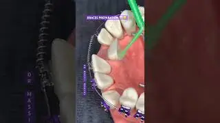 BRACES PREPARATION 🦷😬