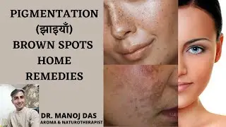 HOW TO REMOVE PIGMENTATION / FRECKLES / BROWN SPOTS / MELASMA I DR. MANOJ DAS