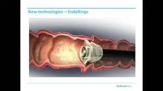 FUSE, E-WAVE, Endorings, etc. - Evidence based benefit for colonoscopy?
