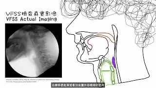 Videofluoroscopic Swallowing Study (VFSS) 吞鋇X光造影檢查