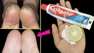 Remove Cracked Heels At Home | Get Beautiful Feet Permanently | Home Remedies
