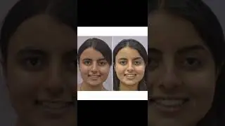 Transformation with braces. #smile #invisalign #life #fashion #attitude #students #study #status #3d