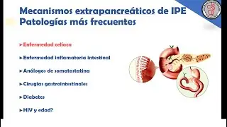 Insuficiencia Pancreática Exocrina de causa extra pancreática