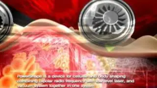 POWERSHAPE: www.power-shape.com :non invasive body contouring using Rf+laser+vacuum