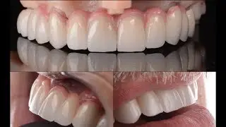 Intraoral scanner PEEK / PEKTON Vitablocs Veneers (Carestream Dental CS3600) Full-Arch Capture