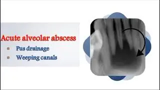 multi visit endodontics