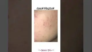 Acne? Dark Spots? Oily Skin? Dullness? 🎀 #shorts #aesthetic #skincare #fyp #glowuptips
