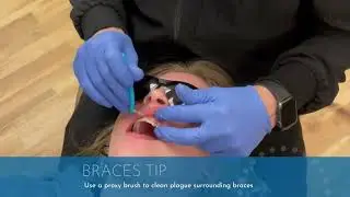 How to use a Proxy Brush on Braces | Jones Family Orthodontics | Monroe, Washinton