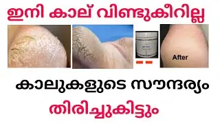 കാല് വിണ്ടുകീറൽ  ഇനിയും ഇല്ല | 7 days foot cream ,