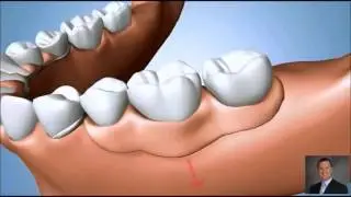 Partial Denture Problems | Implant Dentist Pasadena TX